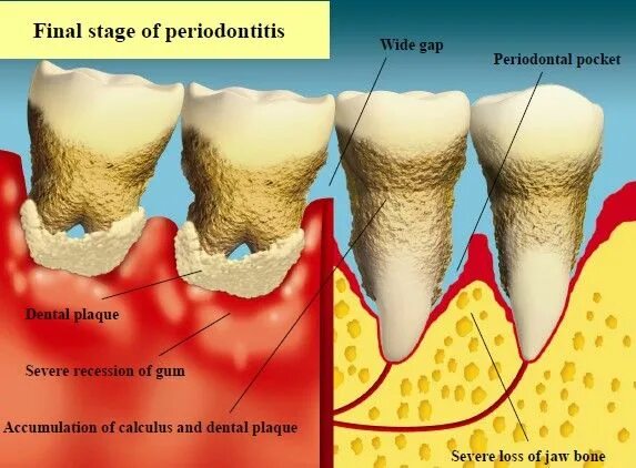Пародонтоз зубов лечение и фото Pin on Dental