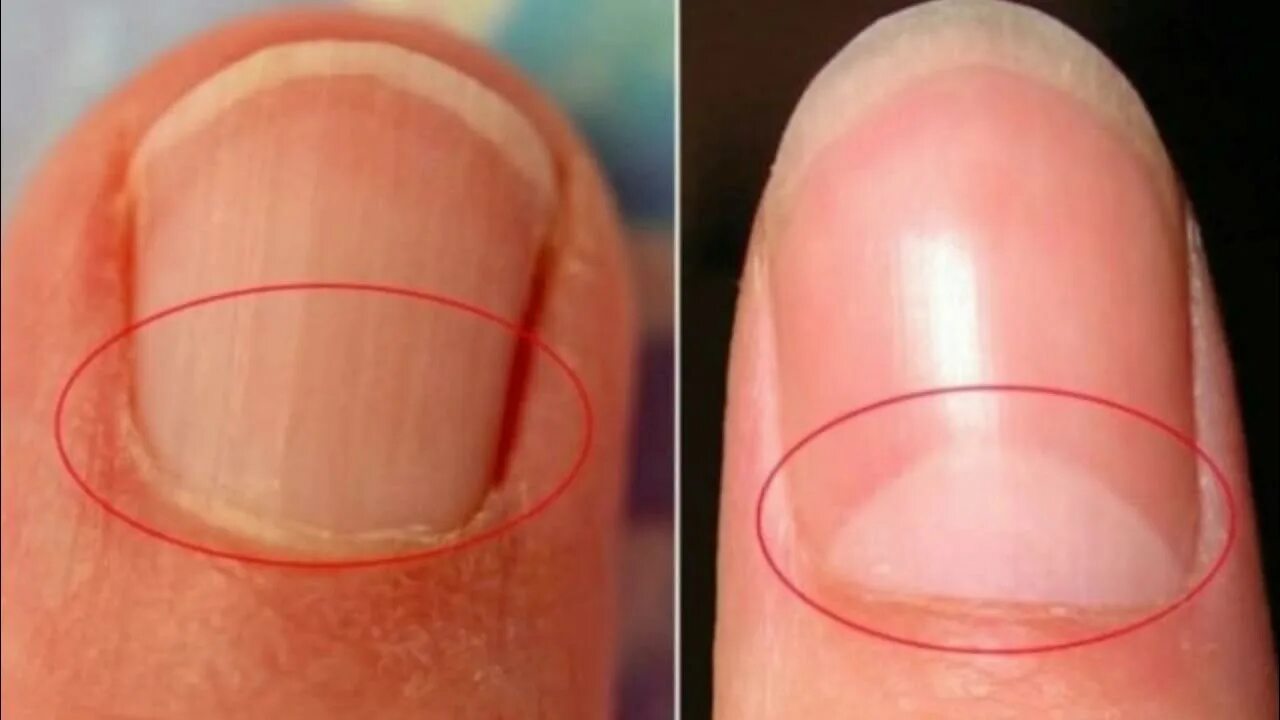 Паронихия ногтя фото Here’s What The Little Half Moon Under Our Fingernails Means - YouTube