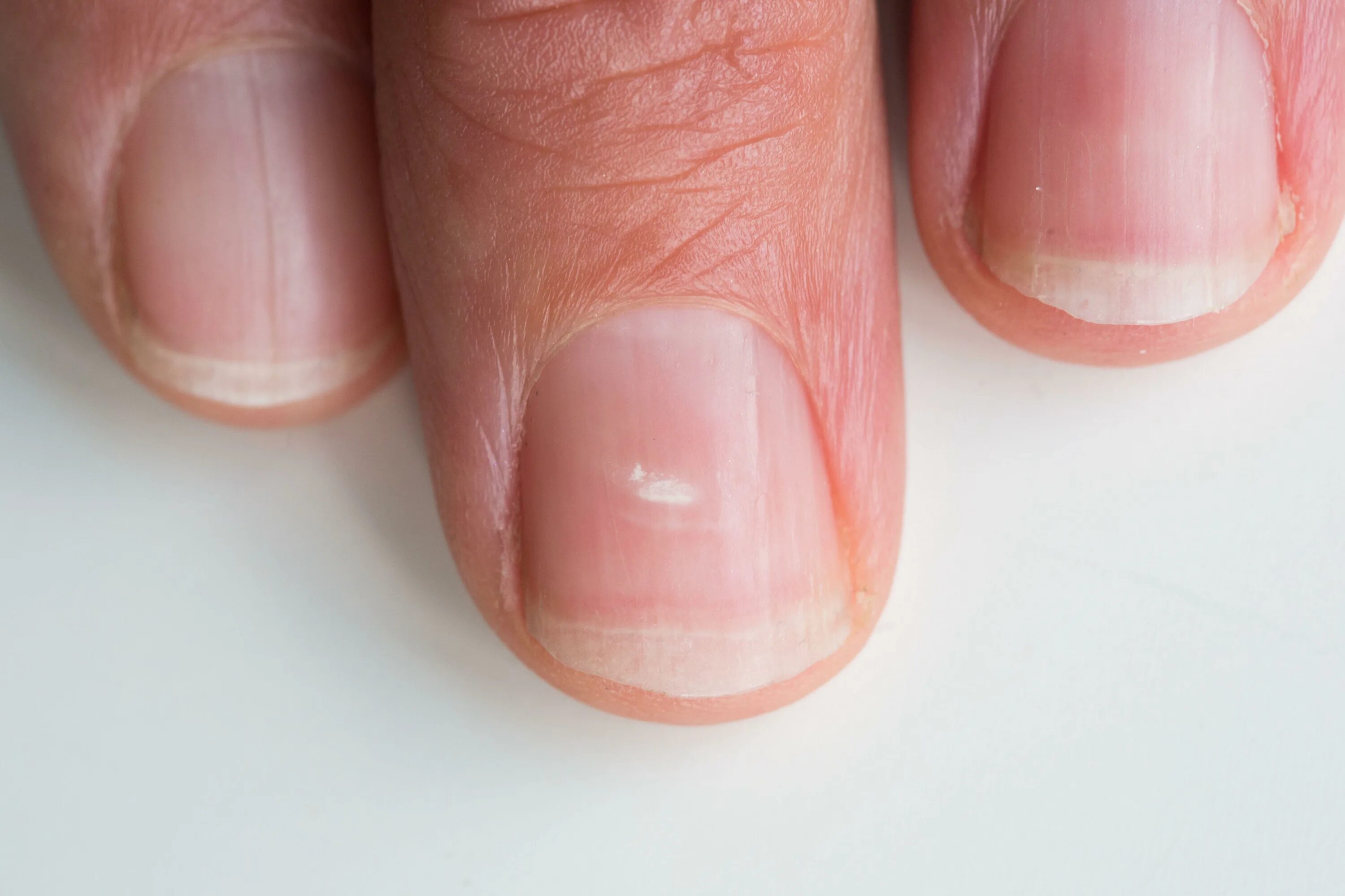Паронихия ногтя фото I'm a dermatologist and you could be suffering from a sinister condition - 9 sig
