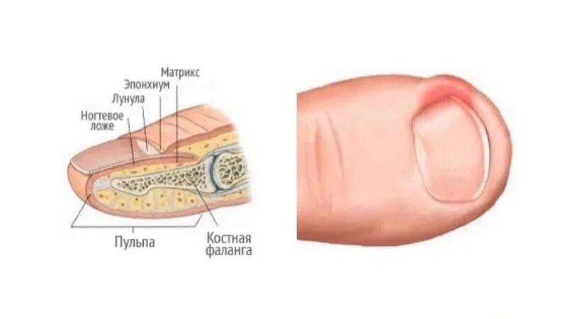 Паронихия ногтя фото Удаление вросшего ногтя - Бушуев Семен Дмитриевич