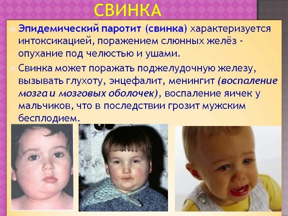 Паротит симптомы у детей фото ЧТО ТАКОЕ ЭПИДЕМИЧЕСКИЙ ПАРОТИТ? - Городские новости - Новости - Официальный сай
