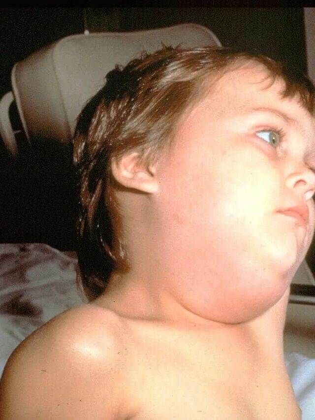 Паротит симптомы у детей фото Mumps Outbreak in Kerala: Check Its Symptoms