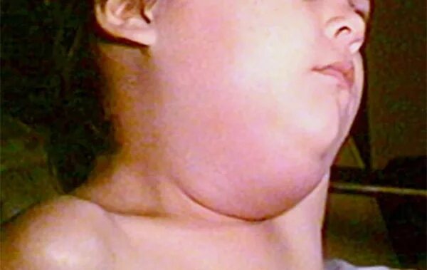 Паротит симптомы у детей фото Child with Lymphedema of the Neck and Parotid Glands - Page 2 of 2 - Journal of 