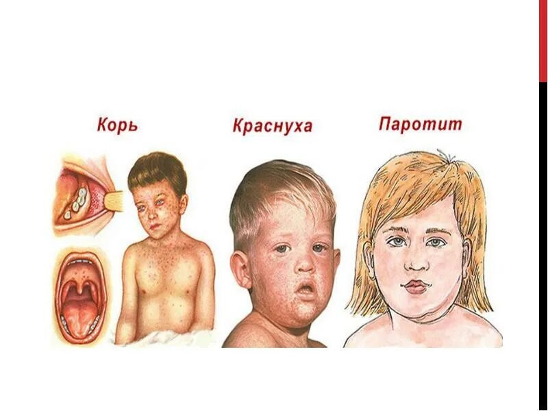 Паротит сыпь фото Эпидемический паротит