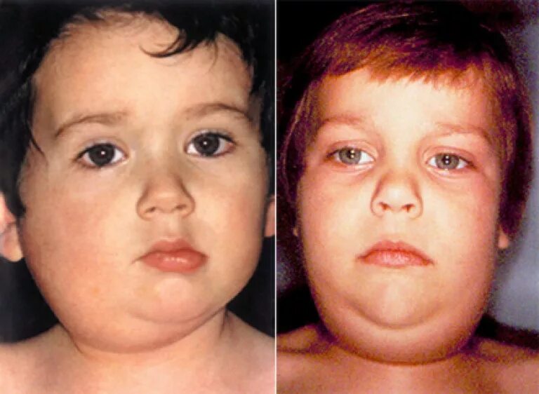 Паротит сыпь фото Mumps (mumps): virus, symptoms in children and adults, treatment. Consequences o