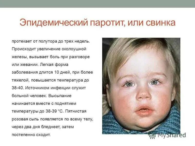 Паротит сыпь фото Какие симптомы при свинке: найдено 89 изображений