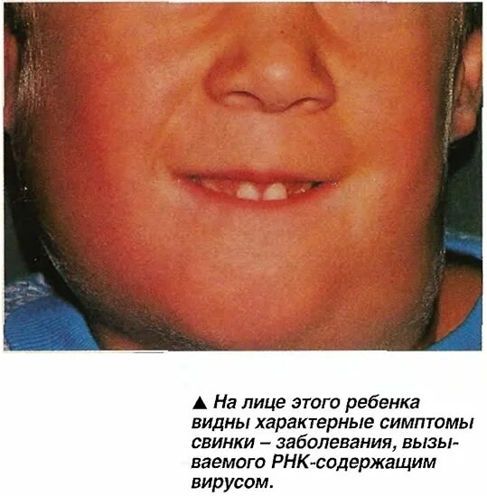 Паротит у детей симптомы и лечение фото На лице этого ребенка видны характерные симптомы свинки" - картинка из статьи: "