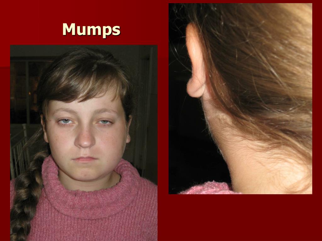 Паротит у взрослых симптомы и лечение фото PPT - Infectious diseases with tonsillitis. Diphtheria PowerPoint Presentation -