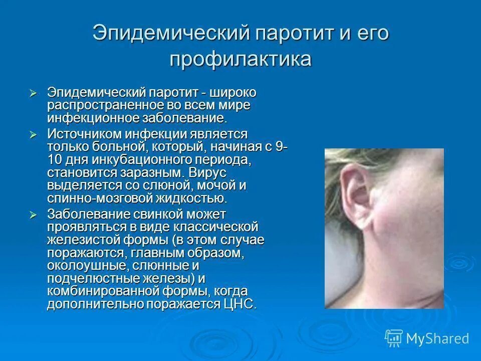 Паротит у взрослых симптомы и лечение фото Картинки БОЛЕЗНЬ СВИНКА СИМПТОМЫ У ВЗРОСЛЫХ ЛЕЧЕНИЕ