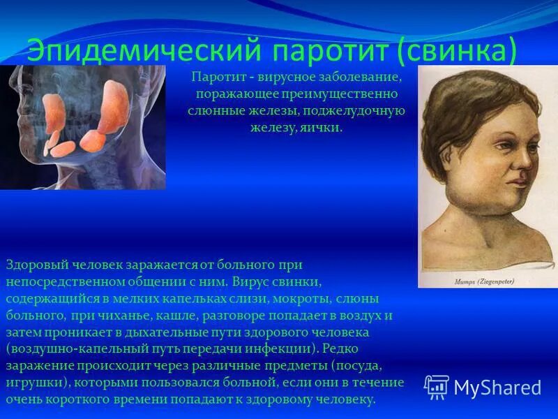 Паротит у взрослых симптомы и лечение фото Пути передачи эпидемического паротита: найдено 90 изображений