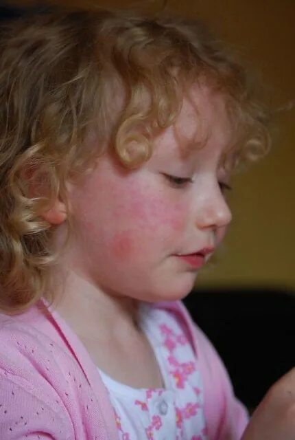 Парвовирус симптомы фото Aoife has Slapped cheek syndrome Mel Cameron Radford Flickr