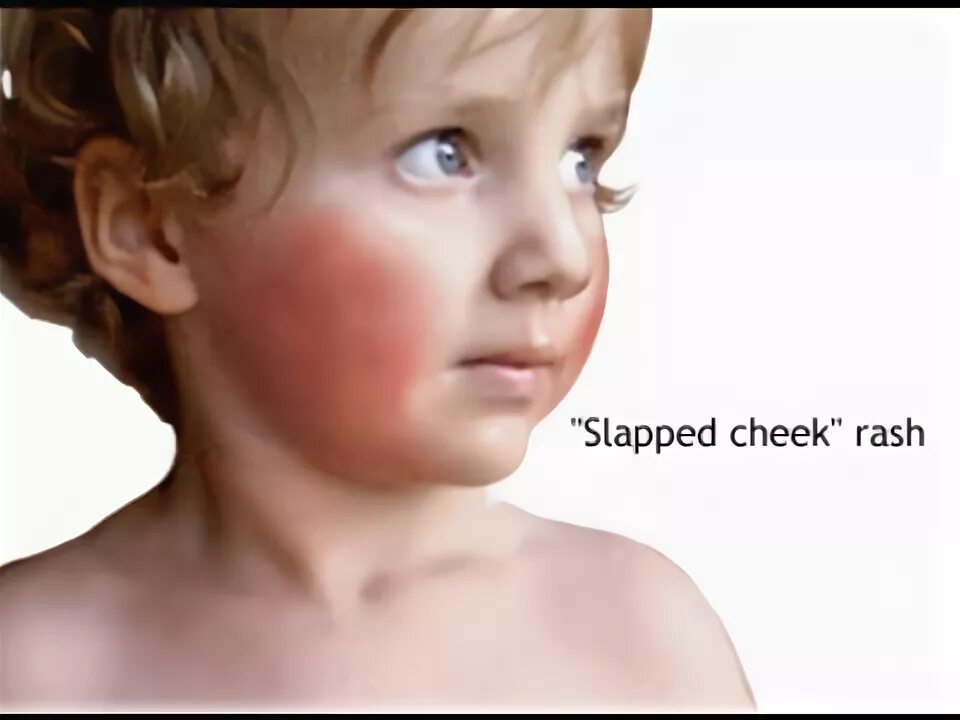 Парвовирус симптомы фото Erythema Infectiosum - YouTube