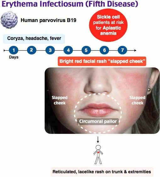 Парвовирус симптомы фото Rosh Review Fifth disease, Medical mnemonics, Pediatry