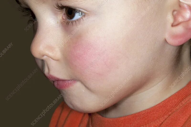 Парвовирус симптомы фото Slapped cheek disease - Stock Image - C019/4245 - Science Photo Library
