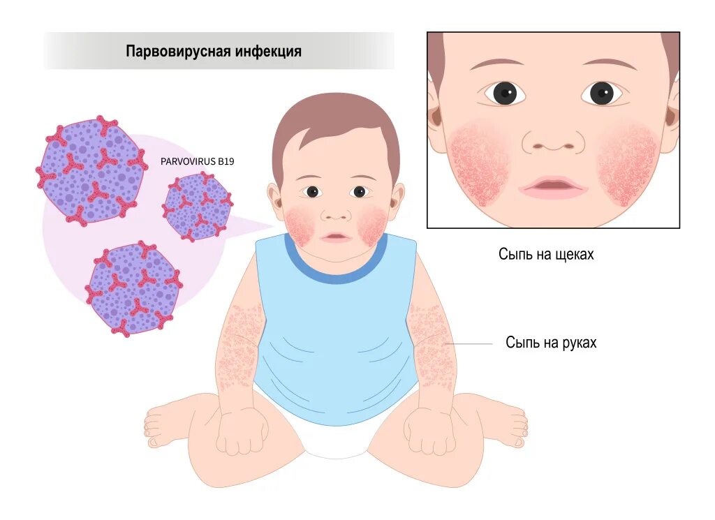 Парвовирус симптомы фото Парвовирусная инфекция - симптомы по дням у детей и взрослых, диагностика и спос