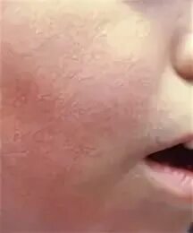 Парвовирус сыпь фото Parvovirus Symptoms and Complications CDC
