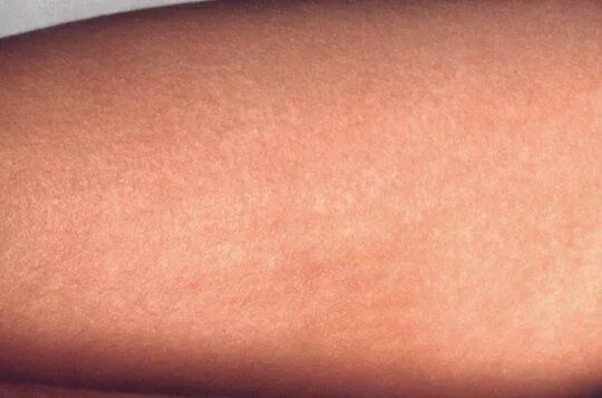Парвовирус сыпь фото у детей на теле Pin on Funky science discoveries