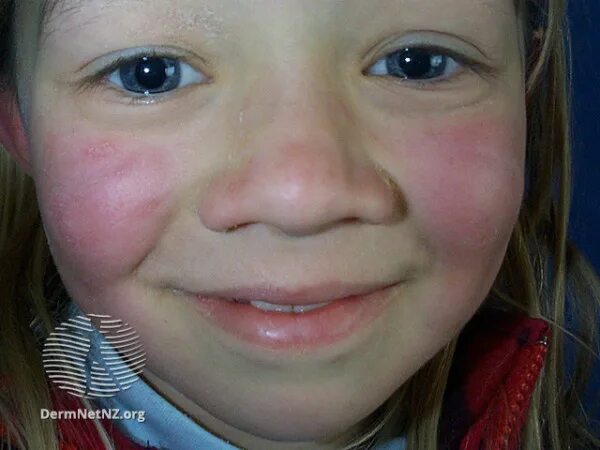 Парвовирусная инфекция симптомы фото Slapped cheek " Whānau Āwhina Plunket