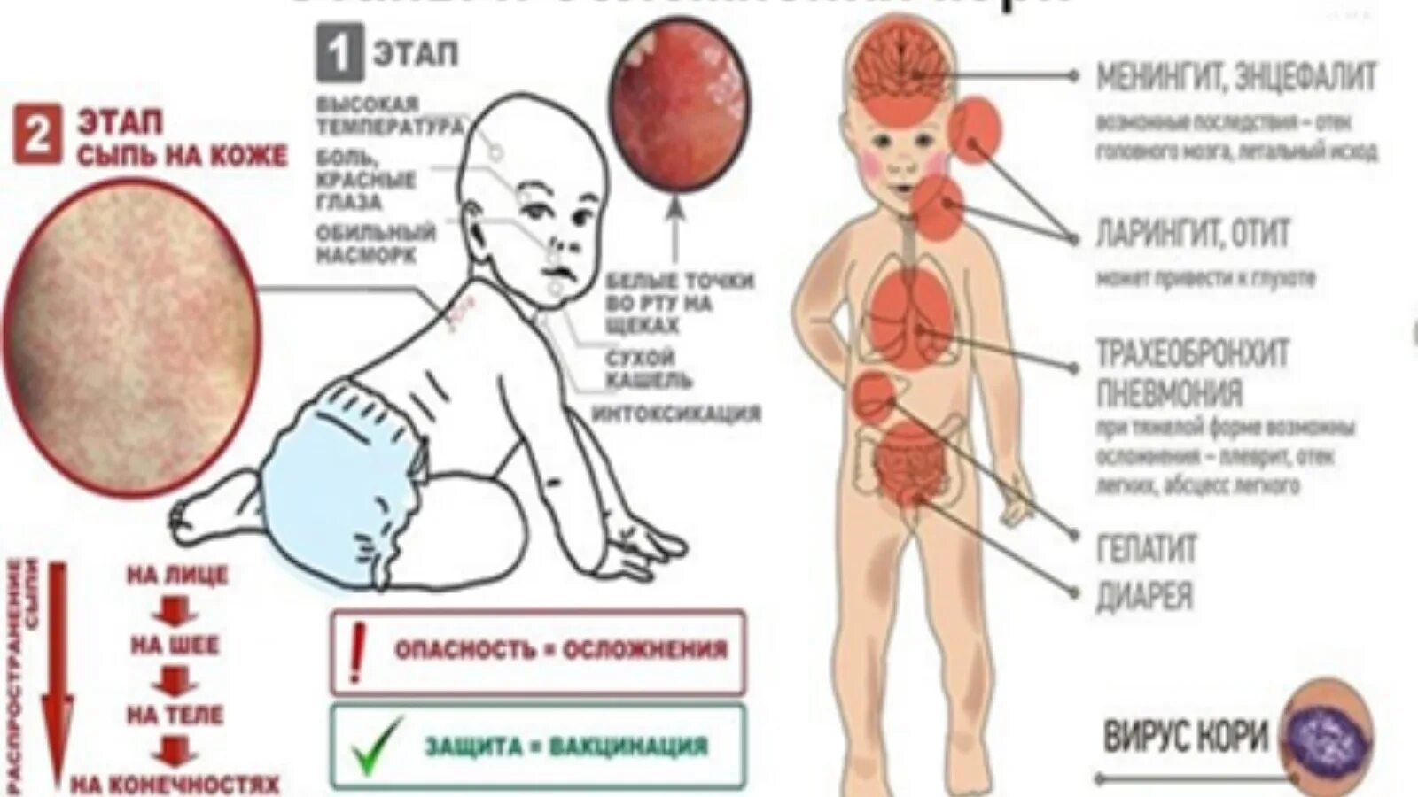 Парвовирусная инфекция у детей фото сыпи Рыбно-Cлободский муниципальный район