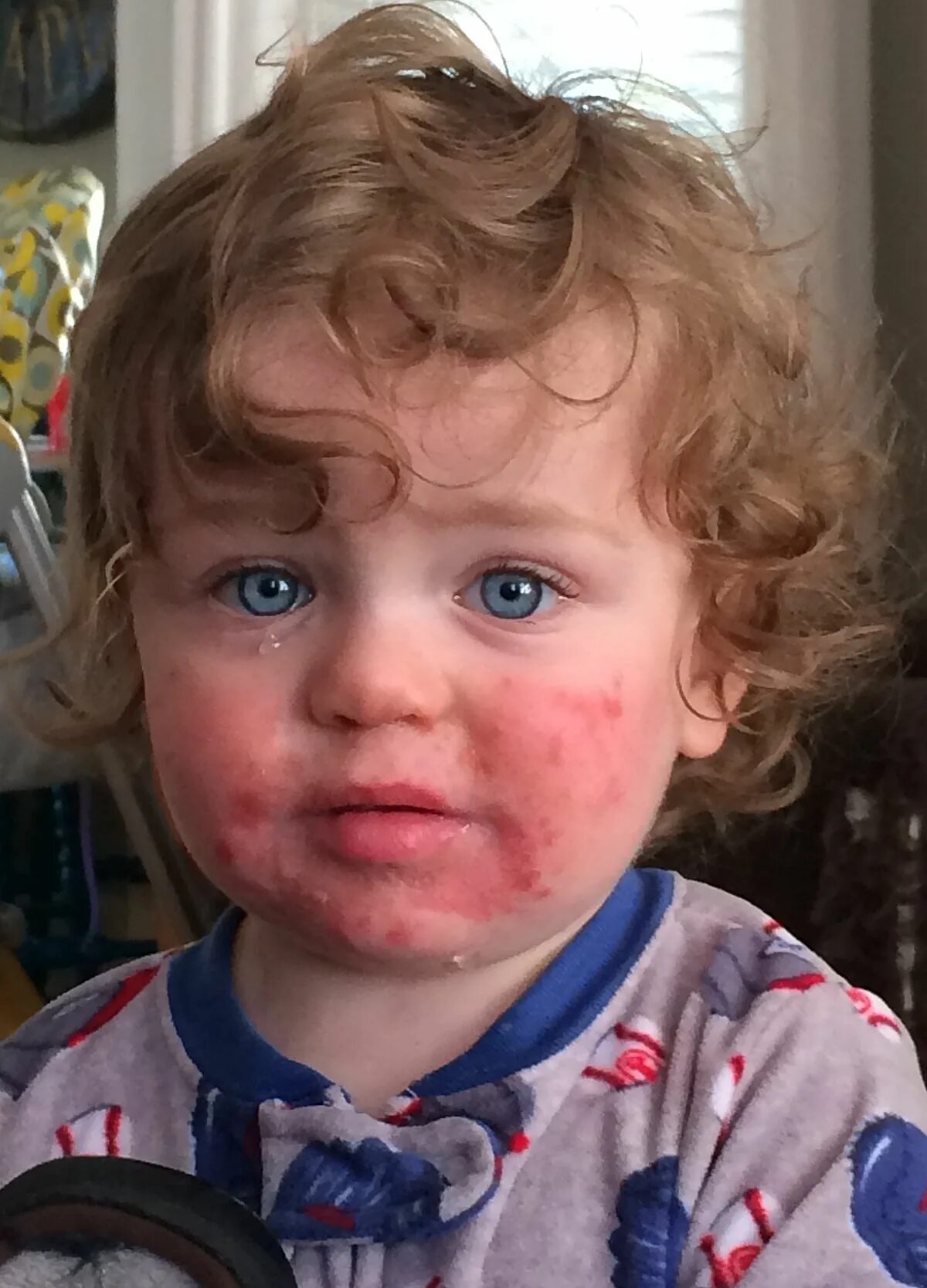 Парвовирусная инфекция у детей симптомы фото Файл:14 month old with Fifth Disease.jpg - Википедия