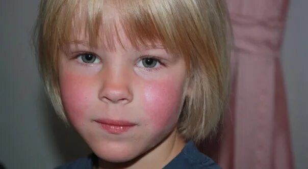 Парвовирусная инфекция у детей симптомы фото Infectious erythema. Synonyms: fifth disease, infection caused by parvovirus B19