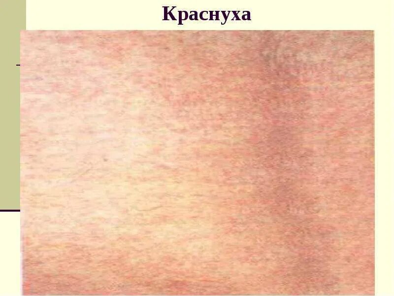 Парвовирусная сыпь фото Симптомы краснухи у детей и подростков - первая помощь в лечении О детском здоро