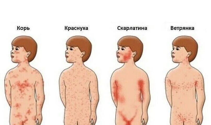 Парвовирусная сыпь фото Болезнь номер 6: найдено 83 изображений