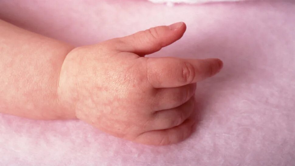Парвовирусная сыпь у детей фото на коже National Maternity Services Framework facing a difficult birth Australian Medica