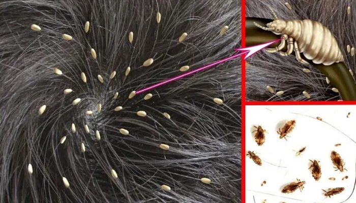 Пастельные блохи фото укусов 5 tratamentos caseiros contra piolho Piolhos e lendeas, Piolhos, Piolho