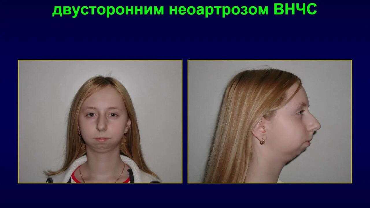 Патологии верхней челюсти у плода фото Первично костные заболевания ВНЧС у детей - YouTube