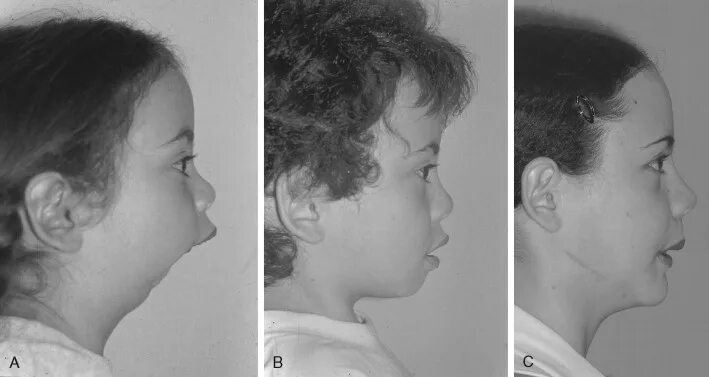 Патологии верхней челюсти у плода фото INTRAORAL DISTRACTION OSTEOGENESIS Pocket Dentistry