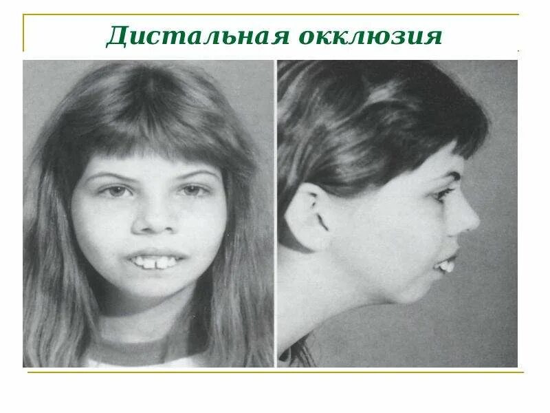 Патологии верхней челюсти у плода фото Институт стоматологии Кафедра ортопедической стоматологии Лекция № 2 (2 курс 3 с