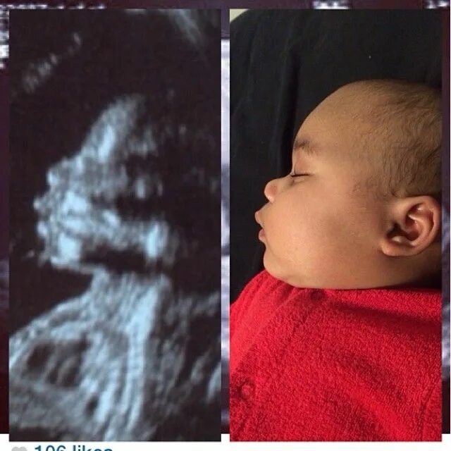 Патологии верхней челюсти у плода фото Pin on Ultrasound