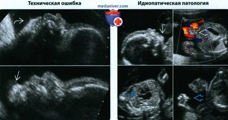 Патологии верхней челюсти у плода фото УЗИ, МРТ при микрогнатии у плода