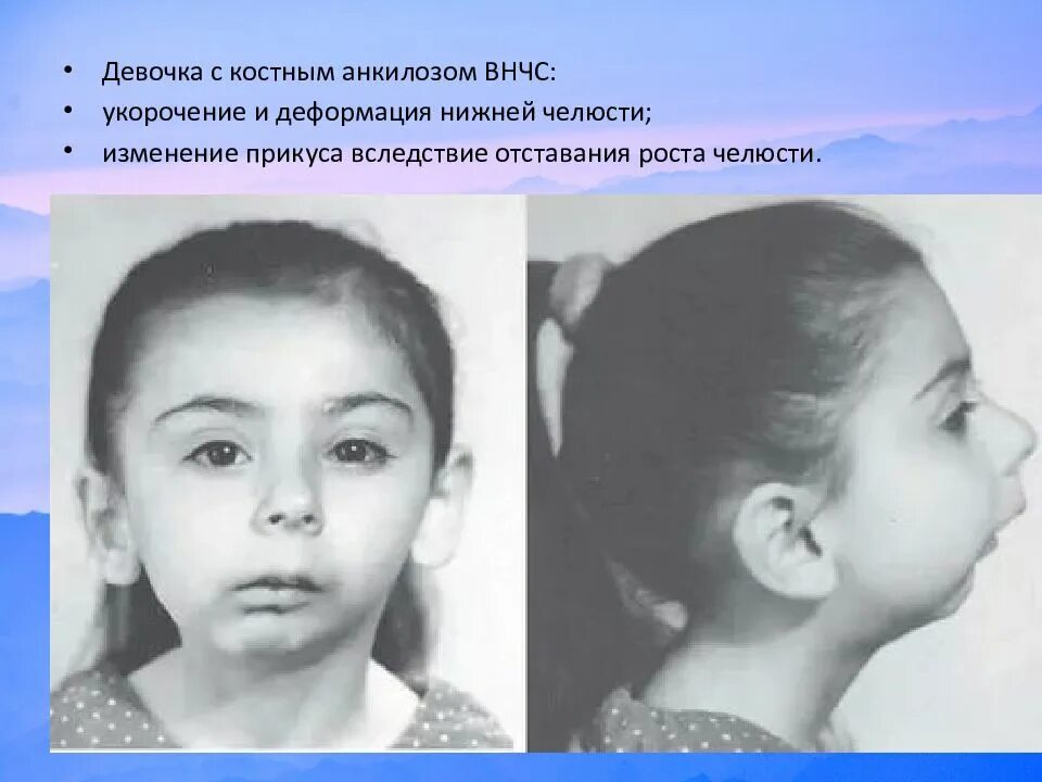 Патологии верхней челюсти у плода фото Аномалии развития нерва