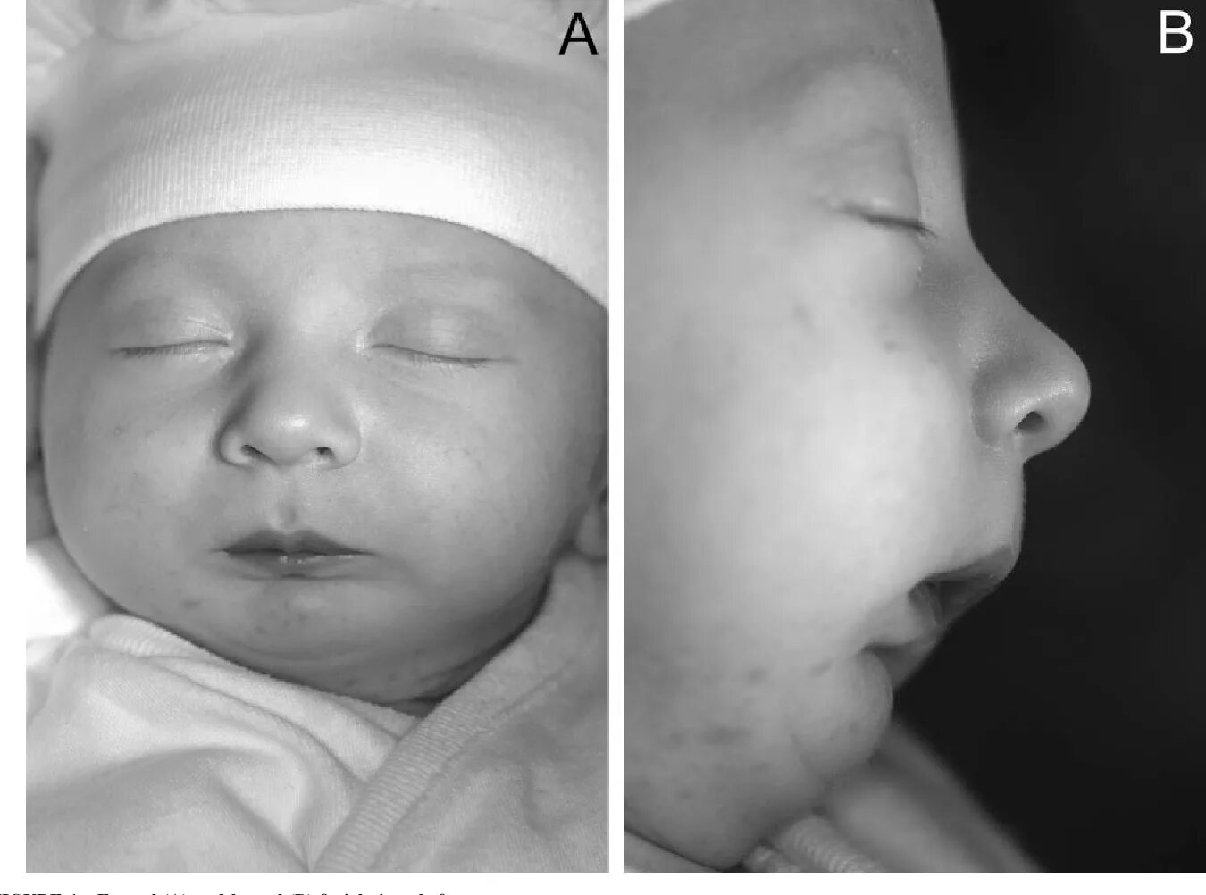 Патологии верхней челюсти у плода фото Figure 1 from Using a Modified Nutrition Plate for Early Intervention in a Newbo