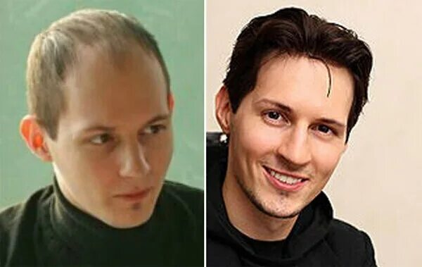 Павел дуров фото до пересадки волос Forbes named Durov the richest billionaire in Dubai. The founder of the social n