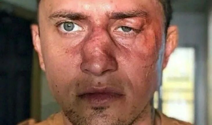 Павел прилучный фото после операции Состояние Павла Прилучного: кто на самом деле изувечил звезду сериала "Мажор"