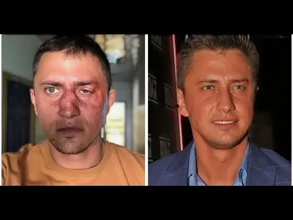Павел прилучный фото после операции Конфликт в ночном клубе: кто избил Павла Прилучного? - YouTube