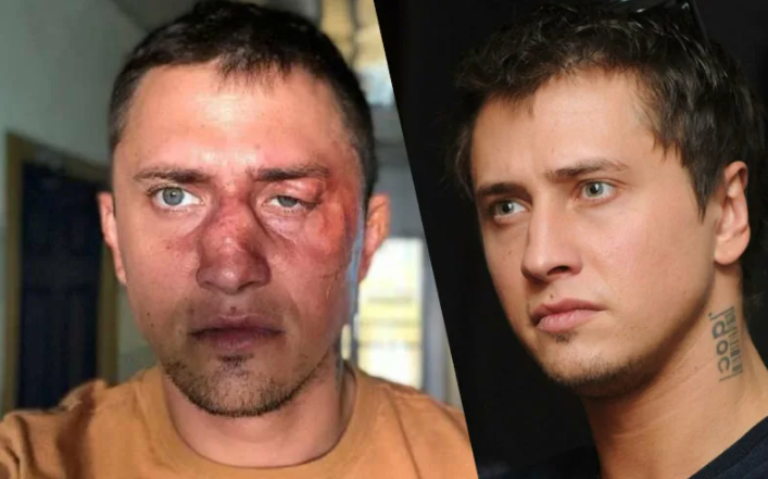 Павел прилучный фото после операции Подробности избиения Прилучного, Глушко продал квартиру, где изменил жене, фото 