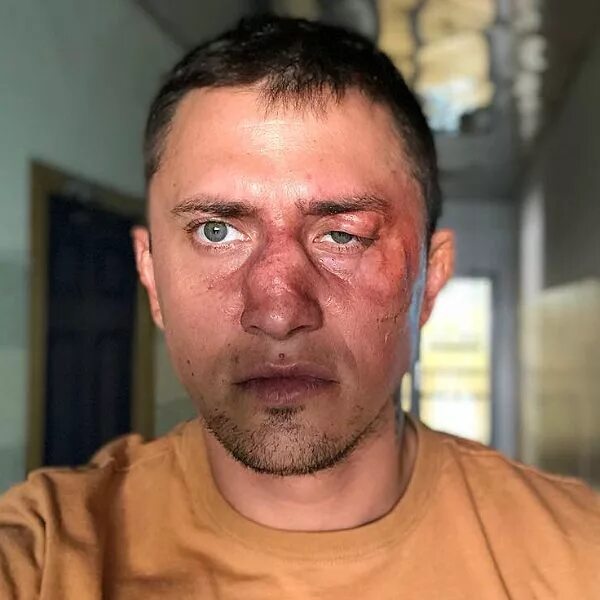 Павел прилучный операция фото Звезда сериала "Мажор" Павел Прилучный опубликовал фото с разбитым лицом - Вокру