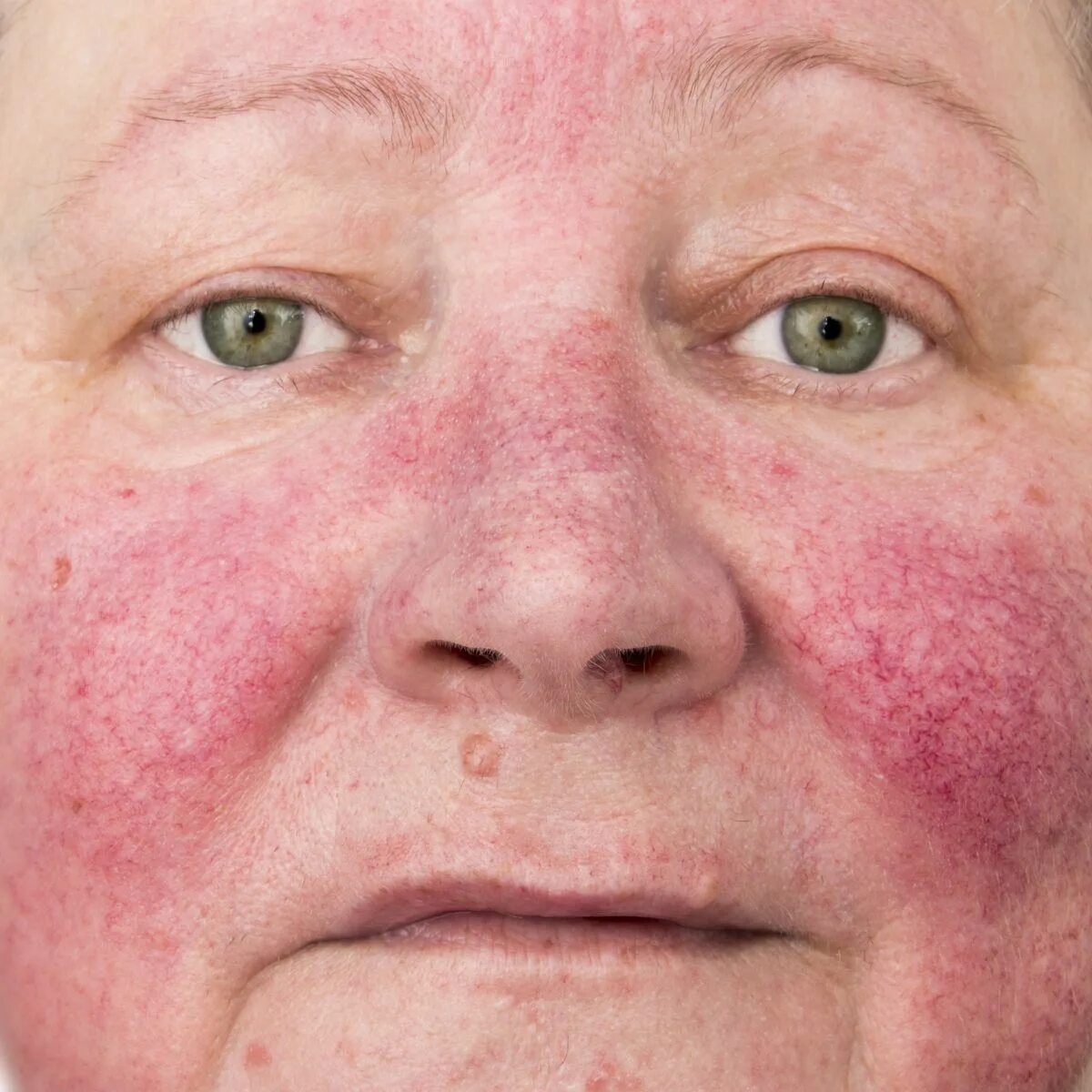 Пероральный дерматит фото лечение Global Look at Data Indicates Which Subtypes of Rosacea Are Most Prevalent