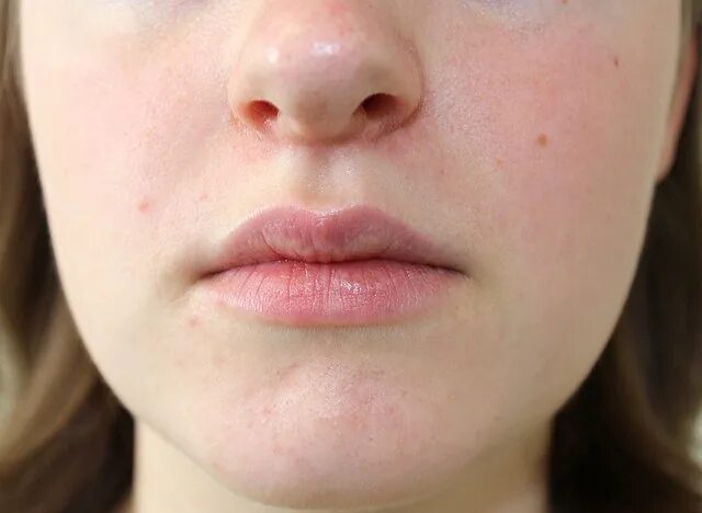 Пероральный дерматит фото на лице у женщин Category:Perioral dermatitis - Wikimedia Commons