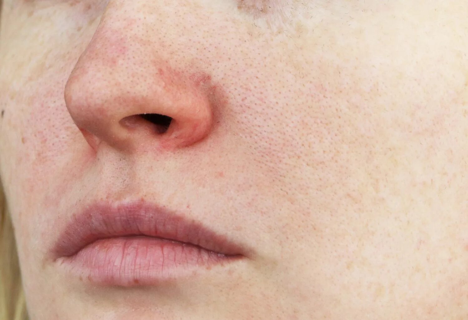 Пероральный дерматит фото на лице у женщин Rosacea: What It Looks Like, Causes, and Treatment