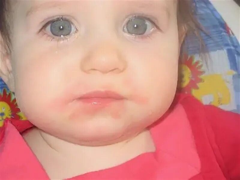 Пероральный дерматит вокруг рта у ребенка фото Our Story with Milk Allergies Allergies, Food allergies, Milk allergy