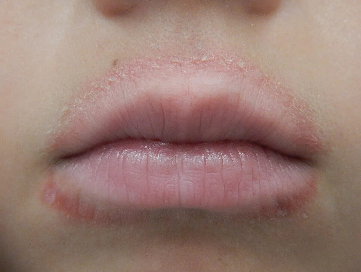 Пероральный дерматит вокруг рта у ребенка фото Lip licker's dermatitis - Wikipedia