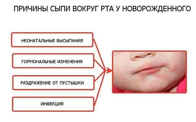 Пероральный дерматит вокруг рта у ребенка фото Раздражение от слюней у грудничка: чем лечить, как предотвратить