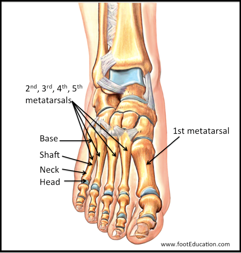 Первая плюсневая кость стопы фото Metatarsal Fractures OrthoPaedia Header