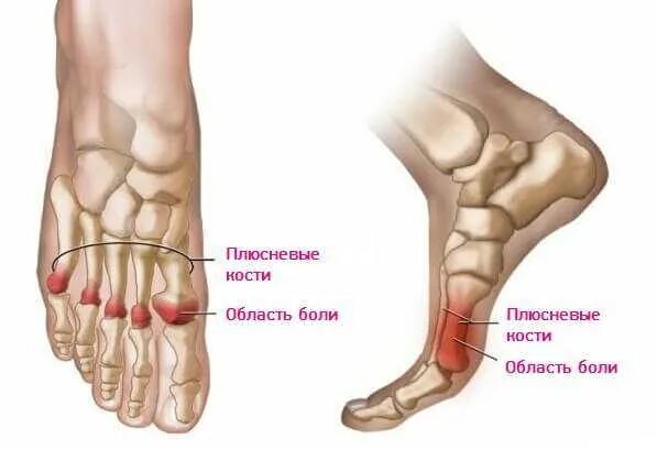 Первая плюсневая кость стопы фото Болит большой палец на ноге где косточка