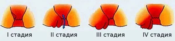 Первая стадия геморроя фото Лечение геморроя народными средствами в домашних условиях. Причины и стадии Поле